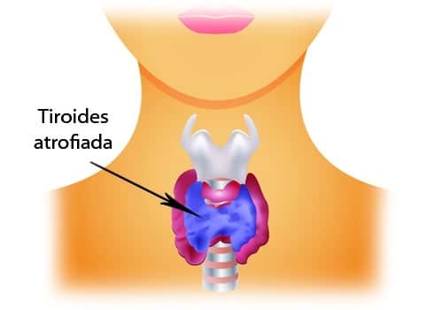 Hipotiroidismo-en- el- Embarazo-2