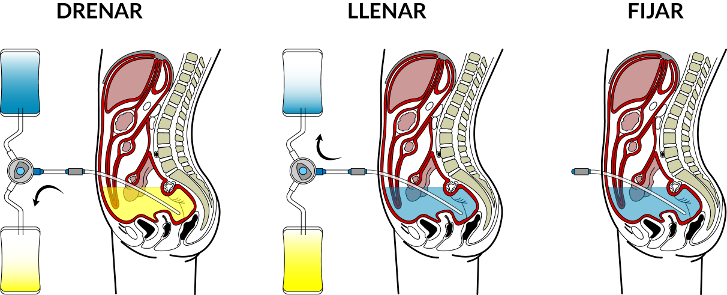 Diálisis-Peritoneal-10