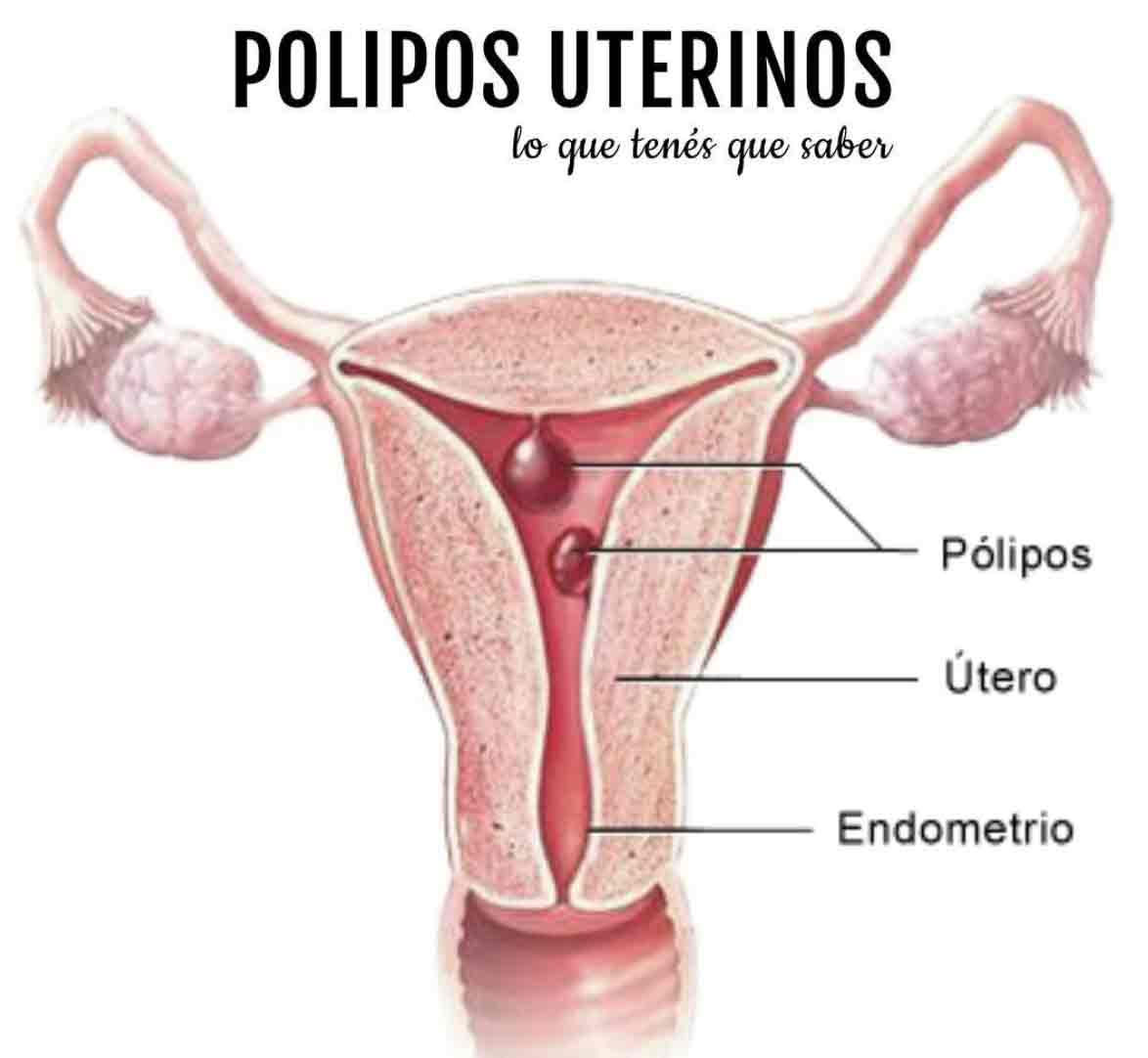 Pólipos Endometriales 