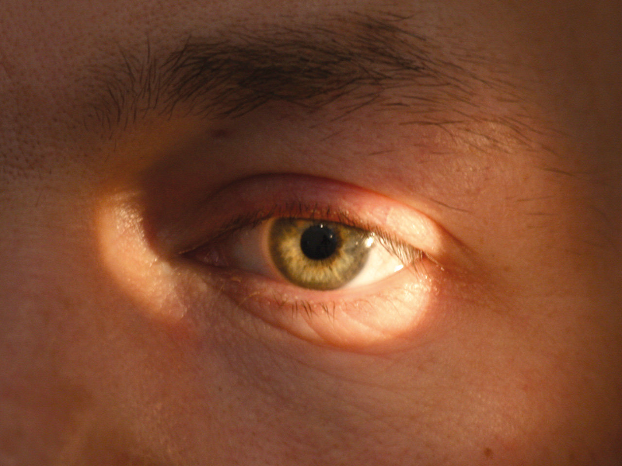 cancer de ojo